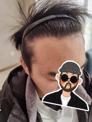 -大麦微针植发丨全国连锁