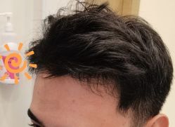 -大麦微针植发丨全国连锁