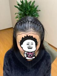 -大麦微针植发全国连锁