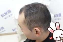 -大麦微针植发丨全国连锁