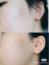 -苗方清颜痘肌研究所