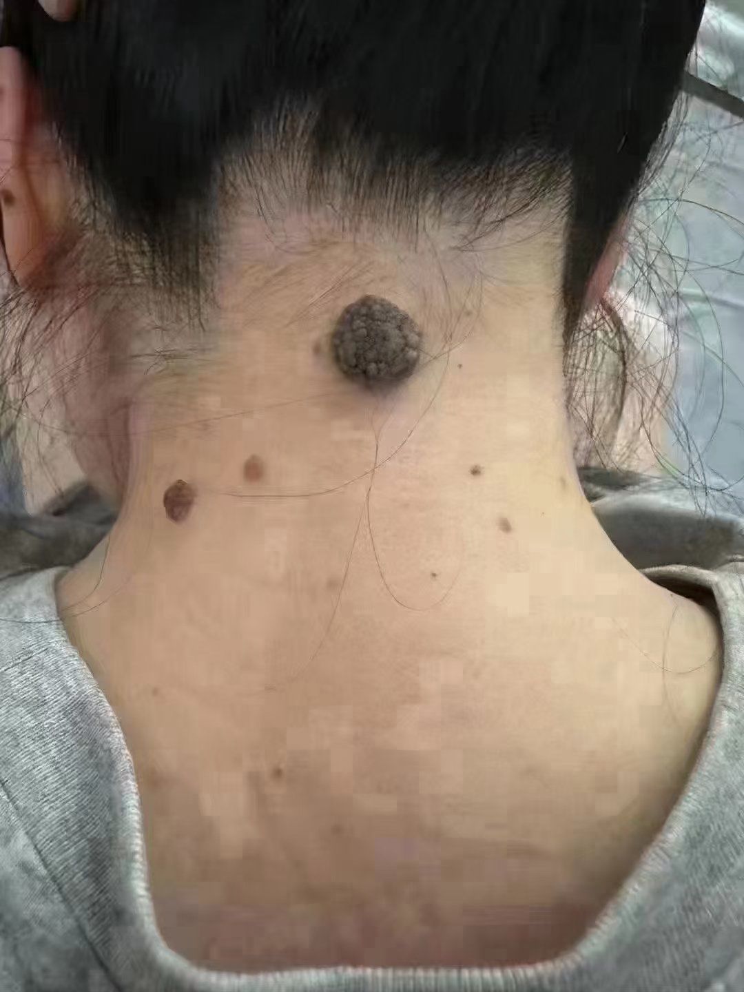 人背痣,穷一世!