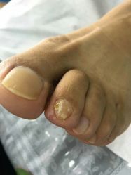 -德哥灰指甲脚气甲沟炎跖疣护理
