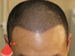 -大麦微针植发丨全国连锁