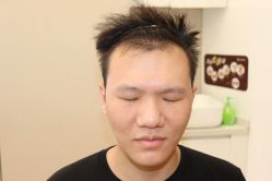 -大麦微针植发丨全国连锁