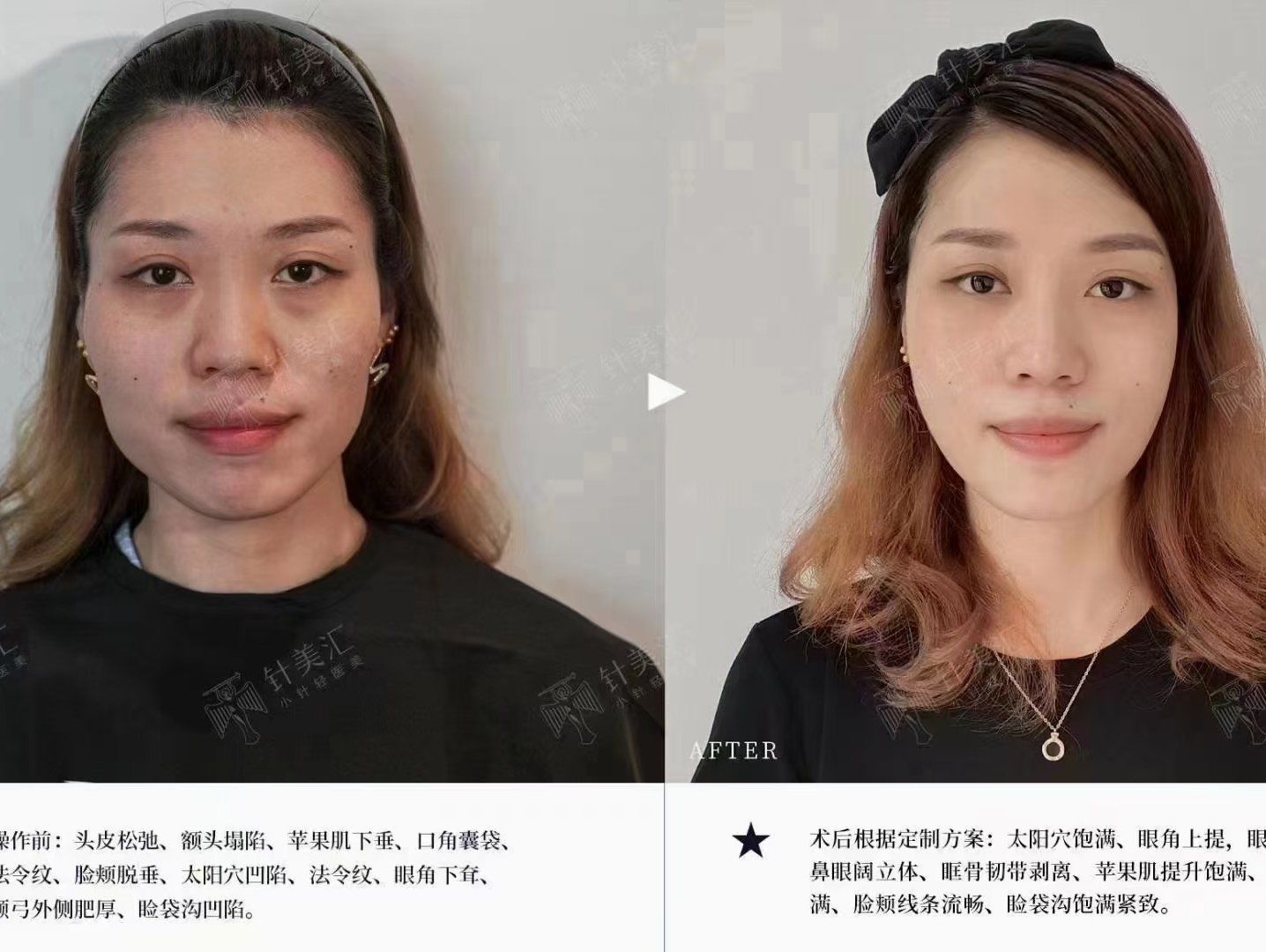 针美汇抗衰前后对比