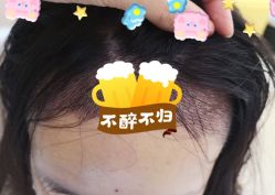 -大麦微针植发全国连锁