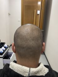 体验前-大麦微针植发全国连锁