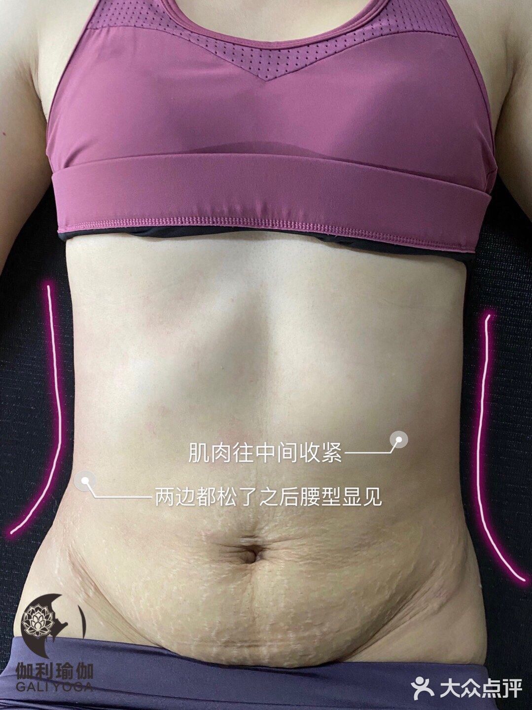 #产后修复