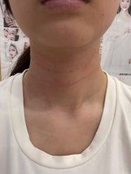 体验后-郡艺医疗美容·微整·眼鼻吸脂