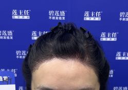 -碧莲盛·不剃发植发
