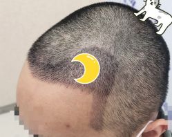 -大麦微针植发全国连锁