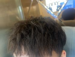 -碧莲盛·不剃发植发
