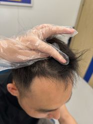 体验后-大麦微针植发全国连锁