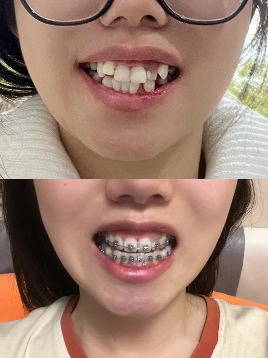 牙齿越变越整齐眼前一亮