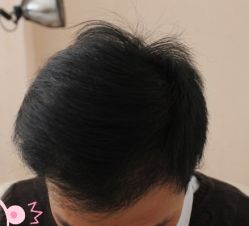 -大麦微针植发丨全国连锁