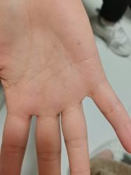 -北京美痣堂古方祛痣斑疣瘊