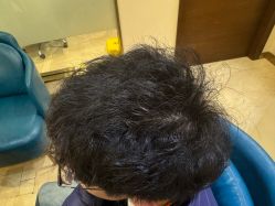 -碧莲盛·不剃发植发