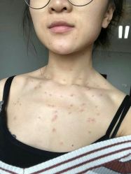 -美丽人生祛斑扁平疣汗管瘤中心