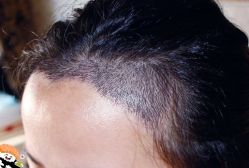 -大麦微针植发丨全国连锁