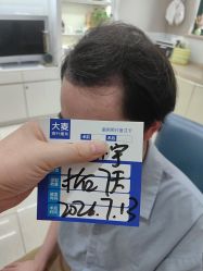 -大麦微针植发丨全国连锁