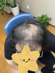 点击看大图 -大麦微针植发全国连锁