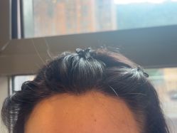 -碧莲盛·不剃发植发