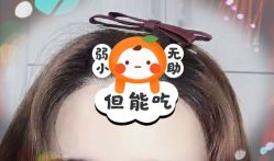 -大麦微针植发全国连锁