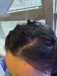 -碧莲盛·不剃发植发