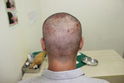 点击看大图 -大麦微针植发丨全国连锁