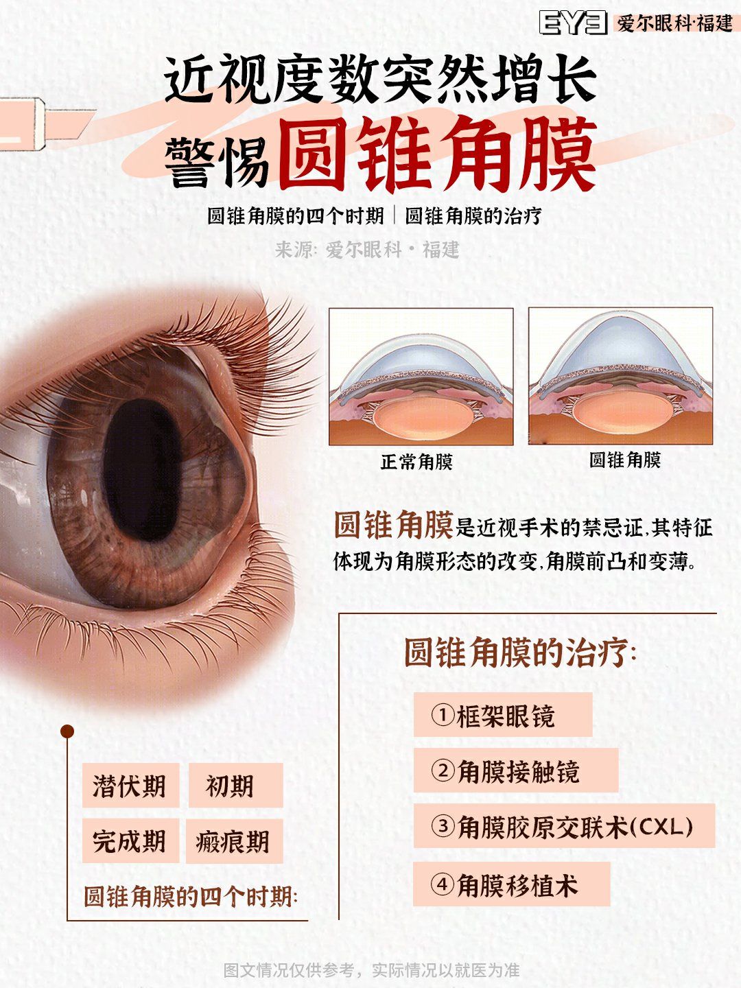 眼睛有这些现象竟是圆锥角膜!你中招了吗?