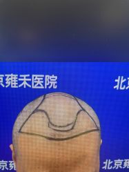 -北京雍禾植发医院