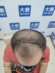 点击看大图 -大麦微针植发丨全国连锁