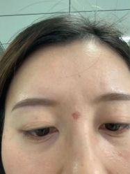 体验后-北京美痣堂古方祛痣斑疣瘊