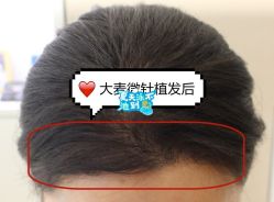 -大麦微针植发全国连锁