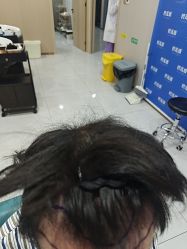 -碧莲盛不剃发植发