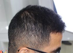 -大麦微针植发丨全国连锁