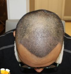 -大麦微针植发丨全国连锁