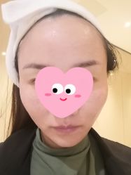 体验后-四川娇点医学美容医院