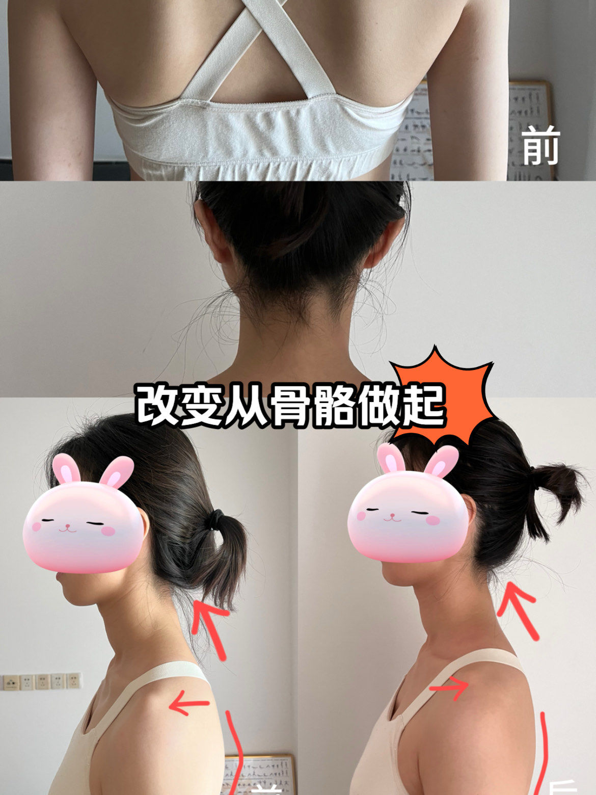 胸椎曲度变直,常伴随肋骨外翻,翼状肩胛,颈椎腰椎问题,为了维持平衡