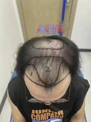 -大麦微针植发丨全国连锁