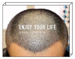 -大麦微针植发全国连锁