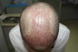 -大麦微针植发丨全国连锁