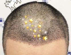 -大麦微针植发全国连锁