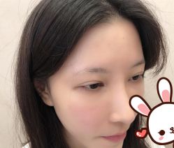 点击看大图 -大麦微针植发丨全国连锁