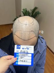 体验前-大麦微针植发全国连锁