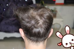 点击看大图 -大麦微针植发丨全国连锁