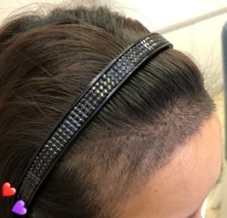 -大麦微针植发丨全国连锁