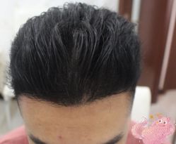 -大麦微针植发丨全国连锁