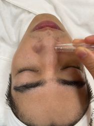 体验前-苗方清颜专业祛痘连锁机构